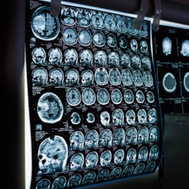 神经细胞为什么那么容易死？