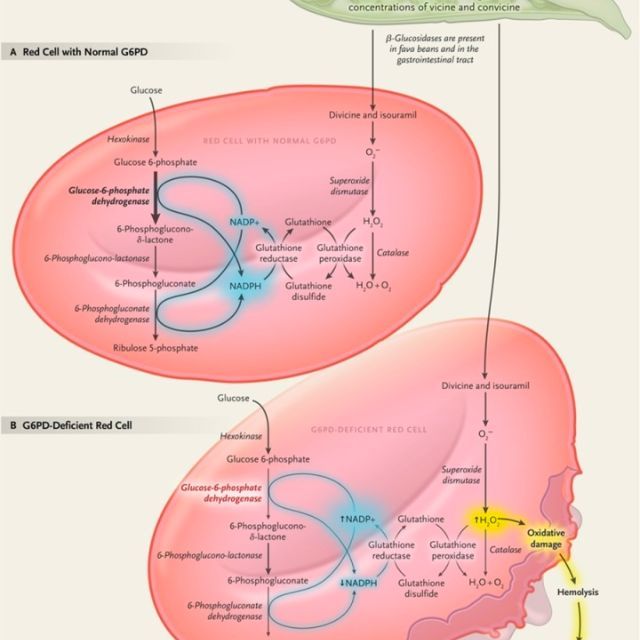 蚕豆病为什么可以吃别的豆,蚕豆中含有什么特殊的,医学原理是什么?
